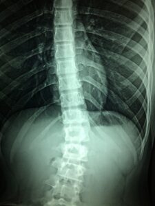 What is a Spinal Cord Injury? (General Overview)